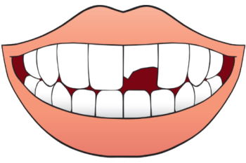 Broken Teeth