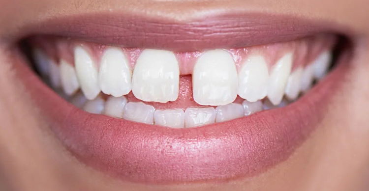 Teeth Gap